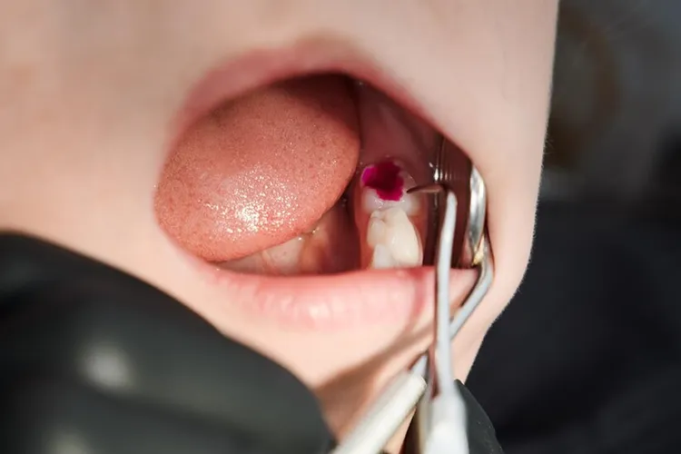 What Do Cavities Look Like?