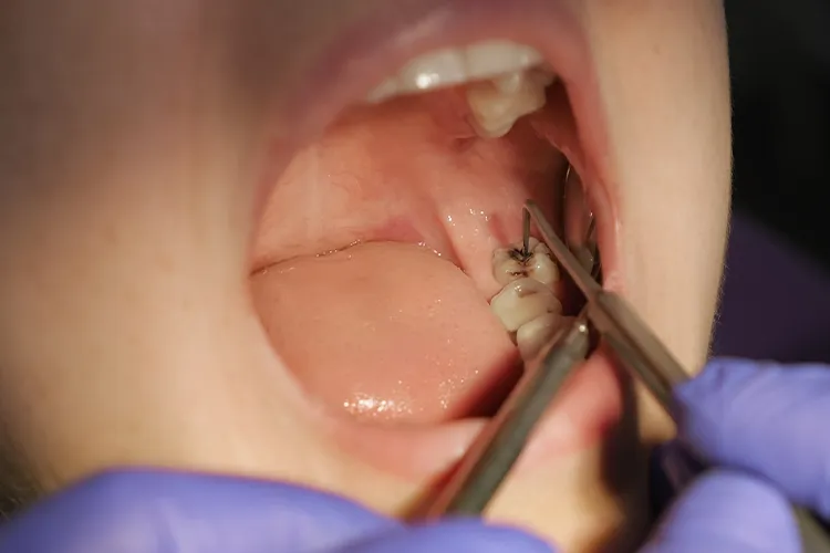 What Does a Cavity Look Like When It First Starts?