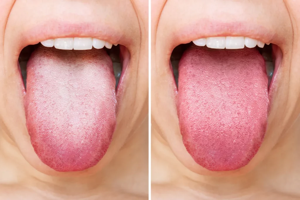 can diet affect tongue color
