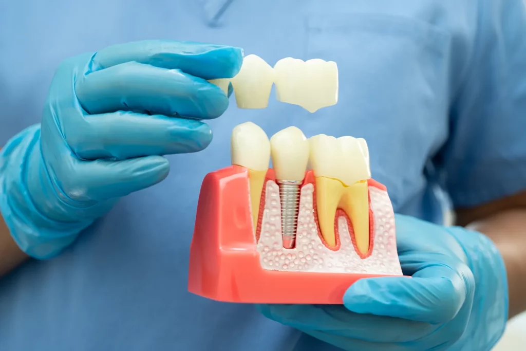 what are dental implants