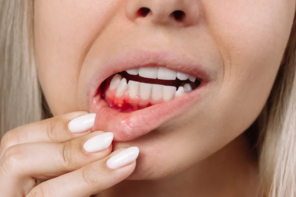 what are receding gums