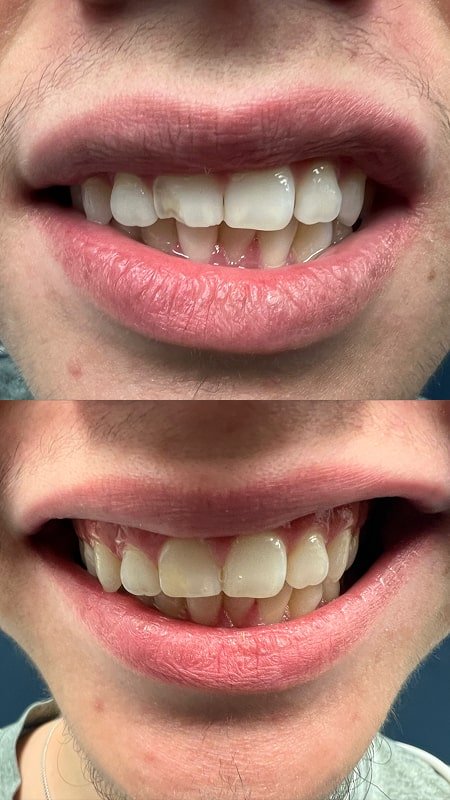 Broken Tooth in Car Accident Repaired with Cosmetic Bonding