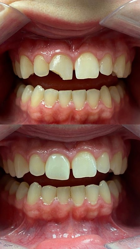 Cracked Tooth in Motorcycle Accident Repaired with Single Veneer