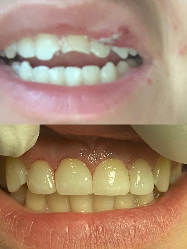 Fractured Teeth From Trip and Fall Replaced with Porcelain Veneers