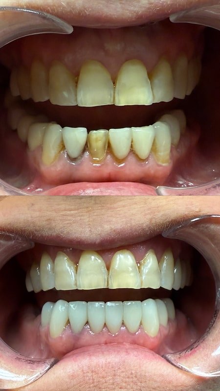 Lower arch broken veneers in accident replaced by brush365 Dental Injury