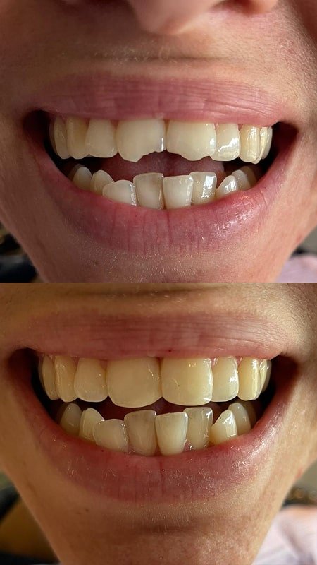 Slip and Fall Damaged Teeth - Repaired With Cosmetic Bonding