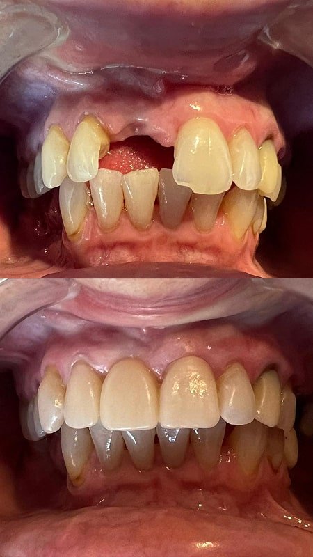 Teeth Knocked Out in Accident Replaced with Esthetic Porcelain Bridge