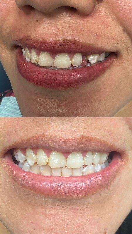 Tooth Fell Out in Car Accident - Replaced with Porcelain Bridge