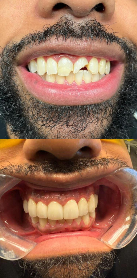 Broken tooth in an assault. Before and after restoration showing full cosmetic and restorative repair