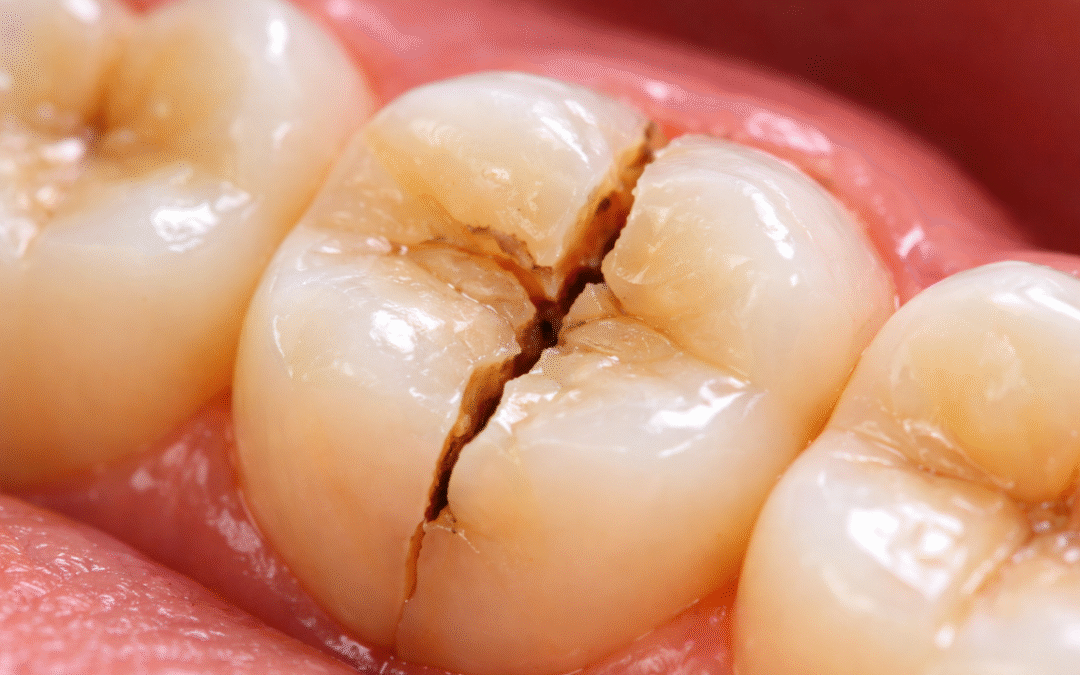 Emergency Dentist Near Me: What to Do If You’ve Broken or Cracked Tooth