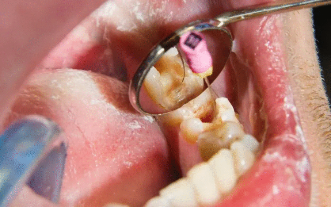 Root Canal Near Me: Why Board-Certified Endodontists in Hurst Matter