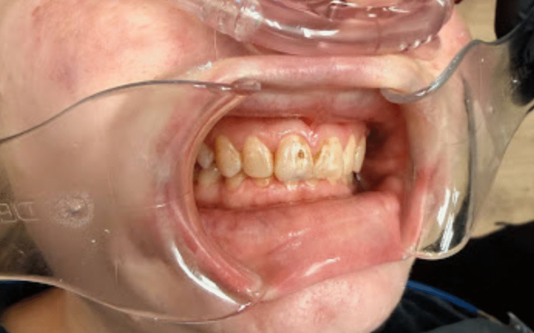 Smile Makeover Results in Arlington: How Thoughtful Changes Improve Confidence