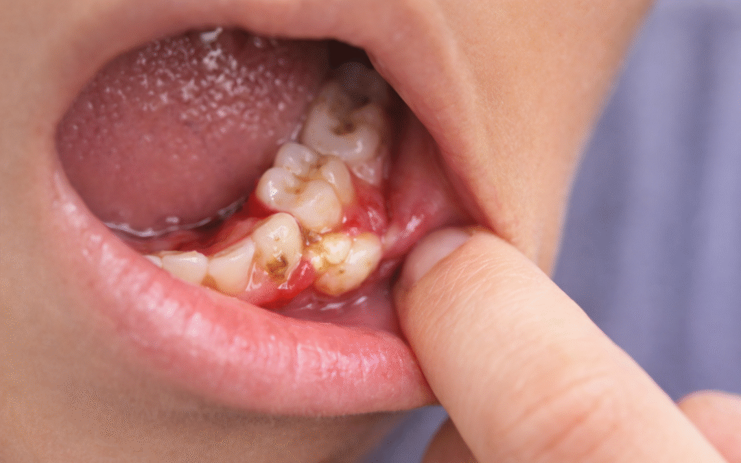 Tooth Infection with Swelling in Allen: When It Becomes an Emergency
