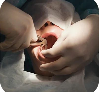 tooth-extractions